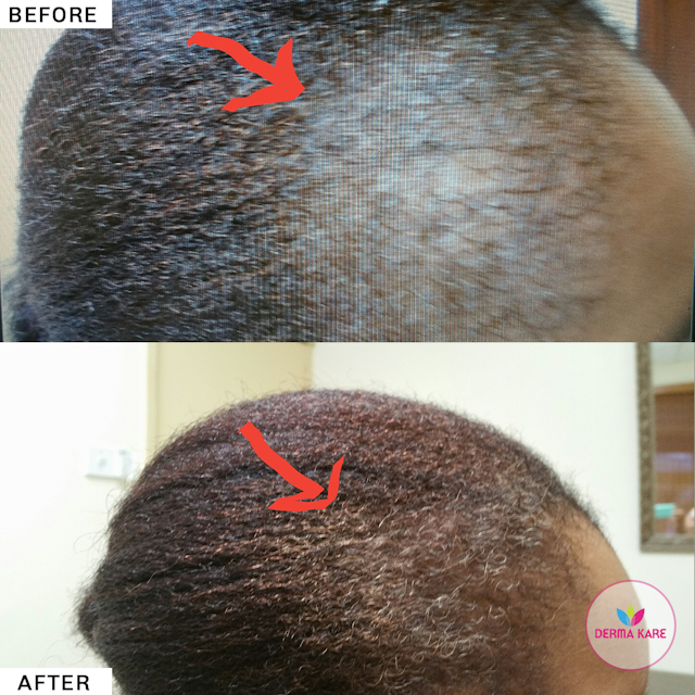 Mesotherapy results picture 1