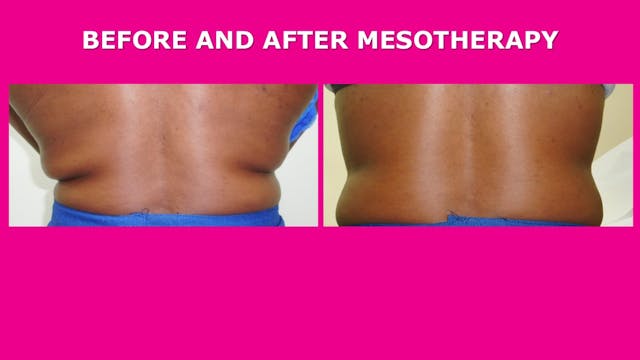 Mesotherapy results picture 6