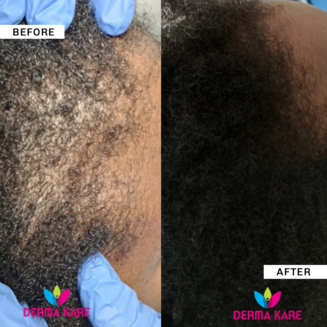 Platelet Power: The Revolutionary Way to Regrow Your Hair blog image