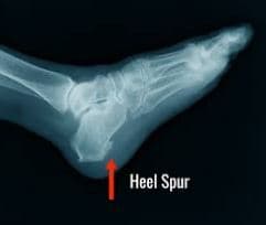 Heel Spurs