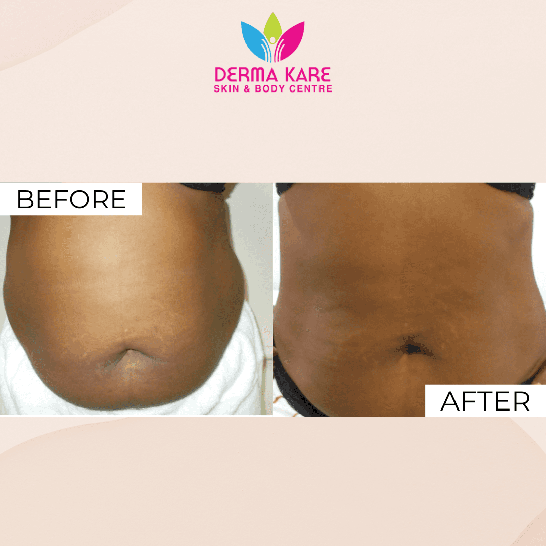 Mesotherapy results picture 1
