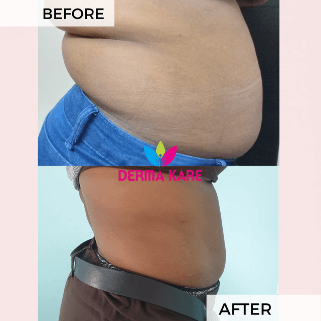 Mesotherapy results picture 3