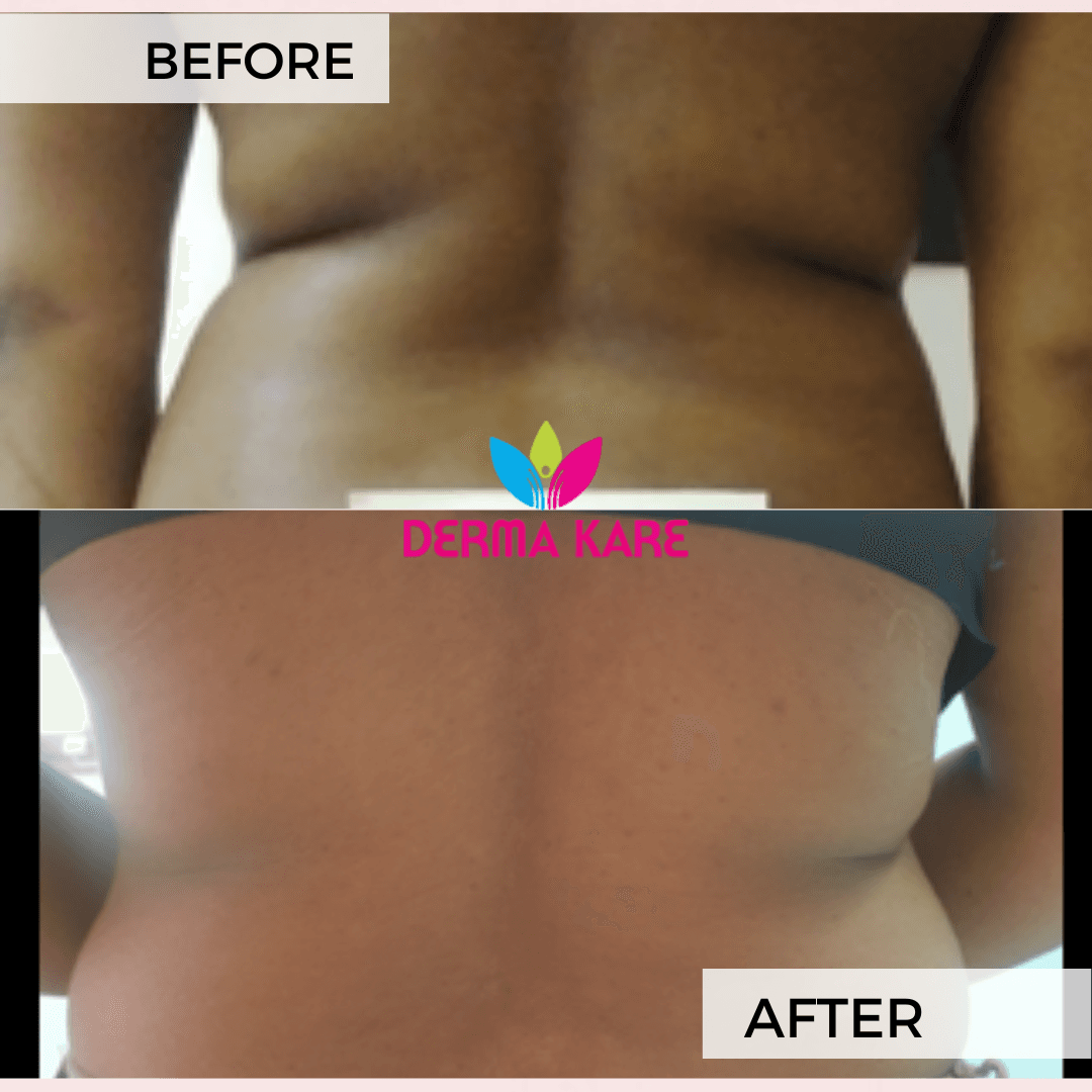 Mesotherapy results picture 6