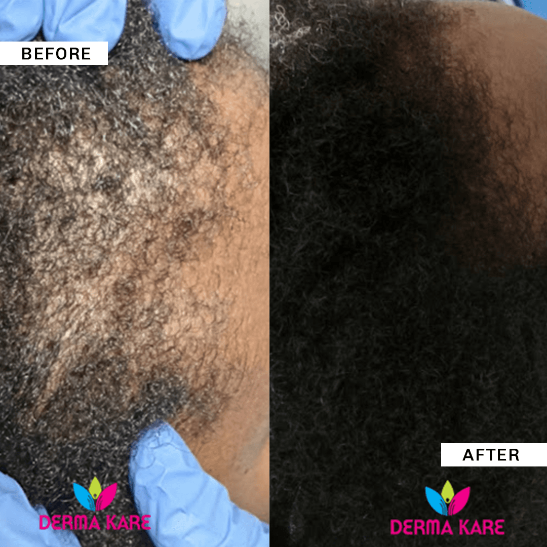 Hair Loss Reversal image