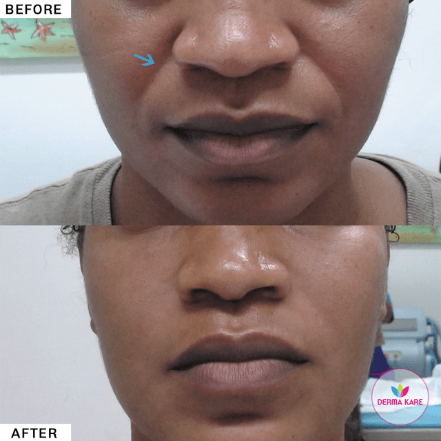 fillers results picture 2