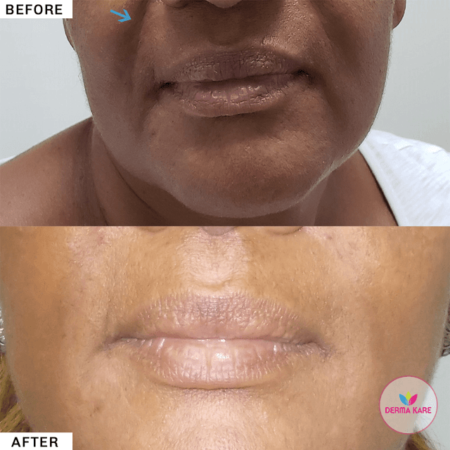 fillers results picture