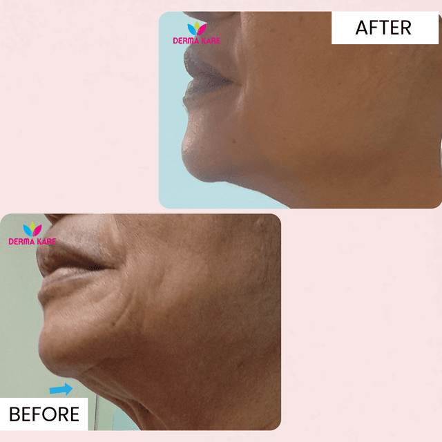 jowls and sagging neck results picture