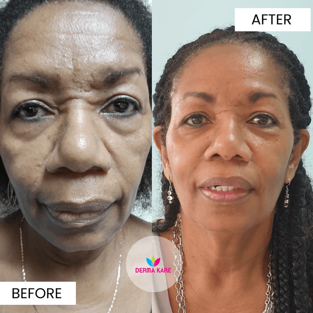 face rejuvination results picture