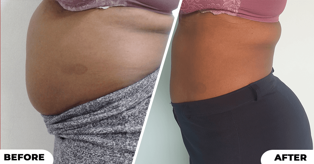Mesotherapy results picture 5