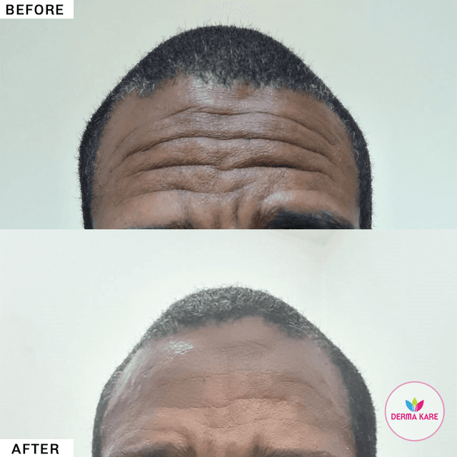 fillers results picture 3