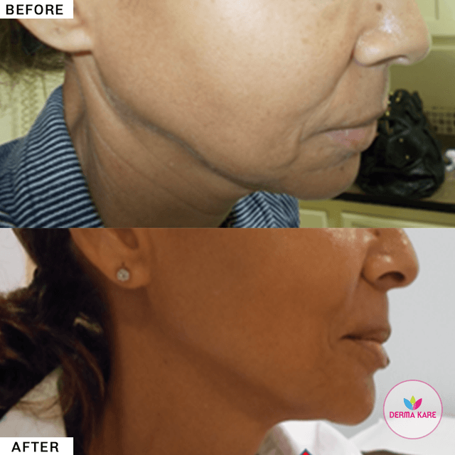 jowls results picture