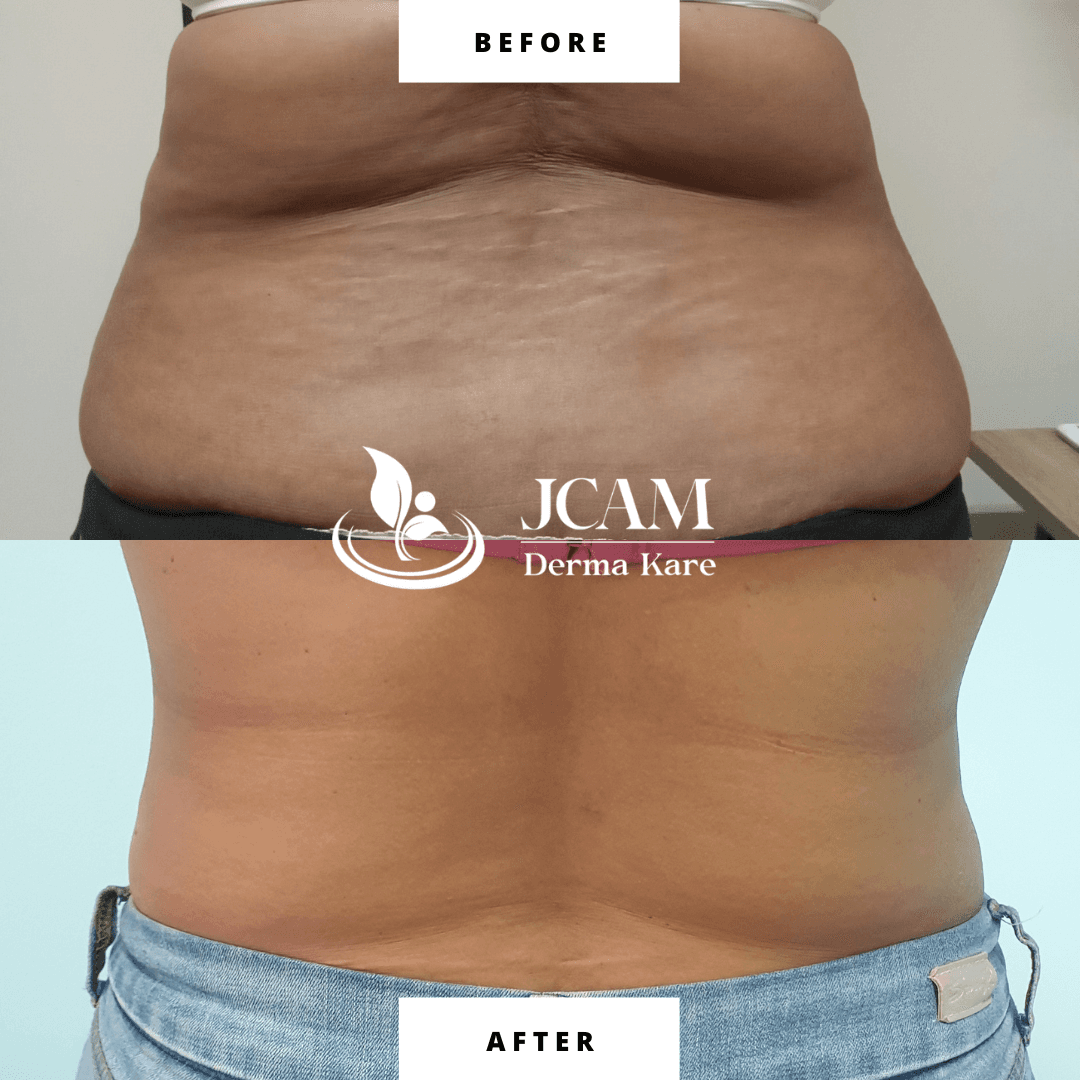 Mesotherapy results picture 7
