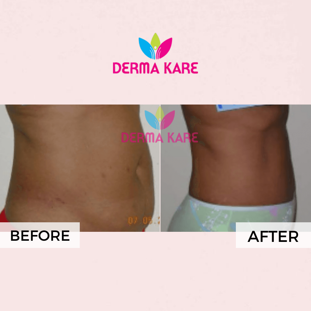 Mesotherapy results picture 2