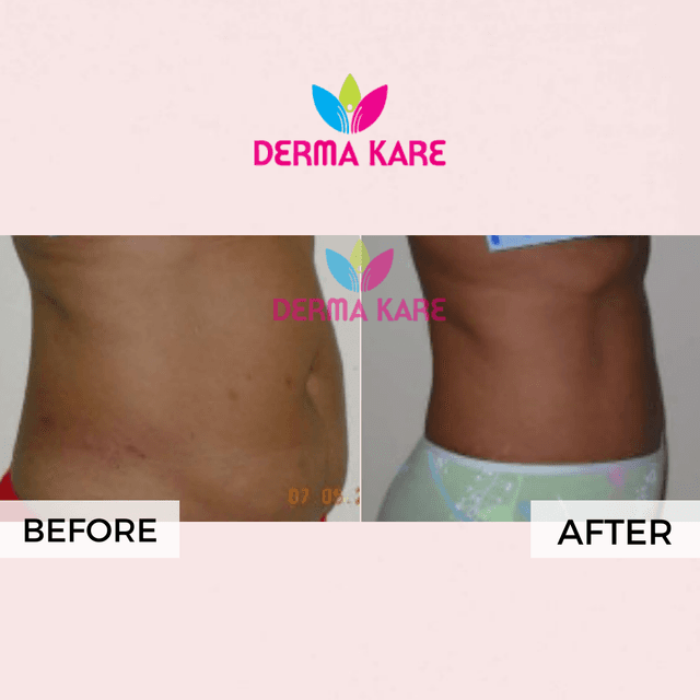 Mesotherapy results picture 2