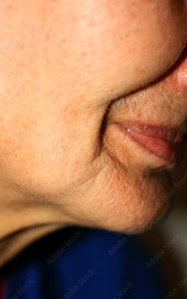 What Causes the Face to Sink? blog image
