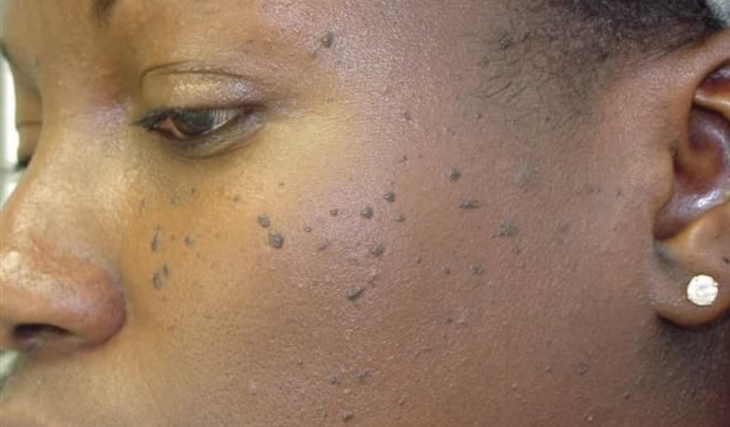 Wart removal