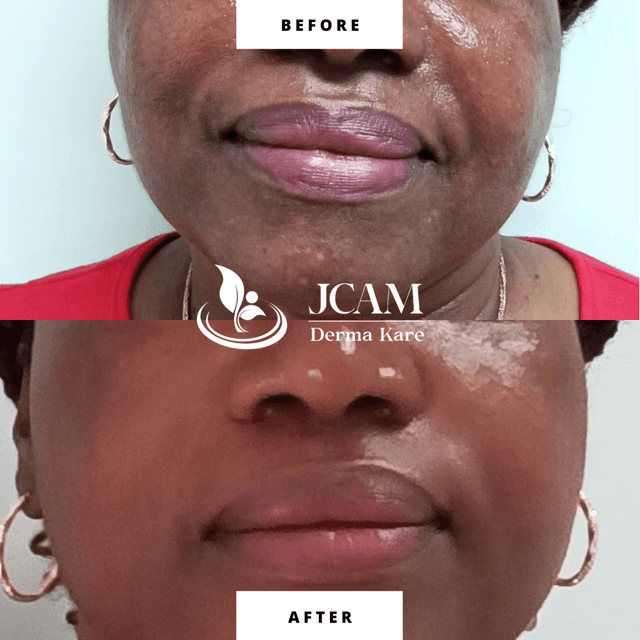 Fillers results jcamdermakare