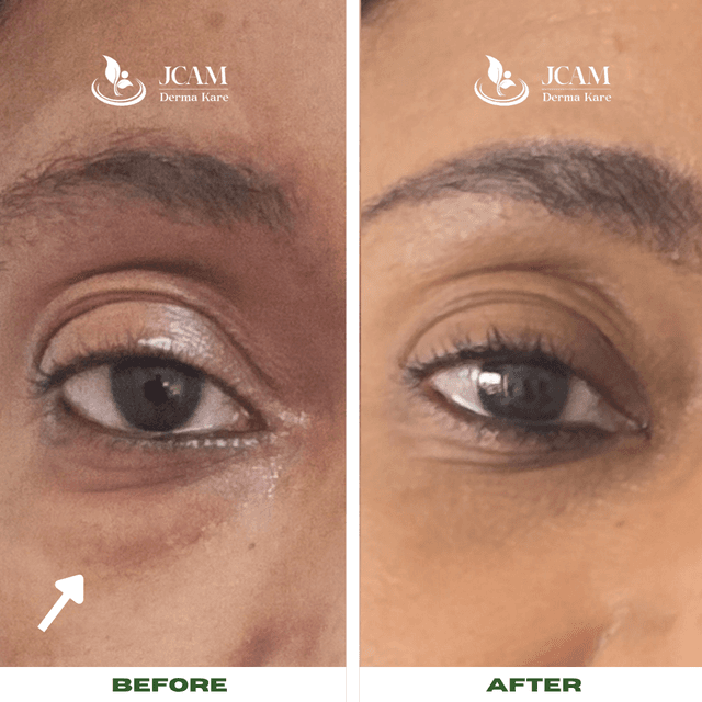 Fillers results jcamdermakare